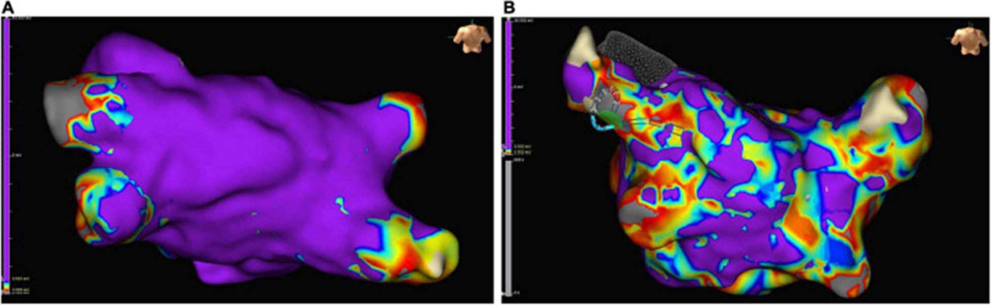 【佳学基因检测】左心房心肌病的基因解码、基因检测及其个性化的治疗 【佳学基因检测】左心房心肌病的基因解码、基因检测及其个性化的治疗